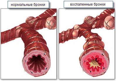 Бронхиальная астма
